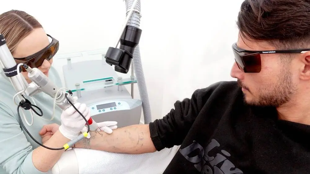 tattooentfernung Behandlung