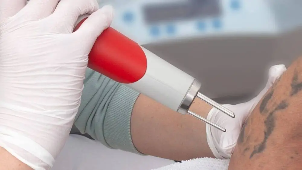 probebehandlung tattooentfernung