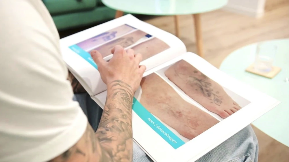 tattoo aufhellung Laser